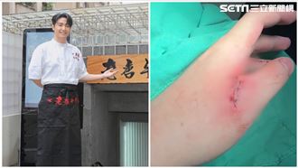 鹿希派還原噴血過程！縫5針傷勢照首曝光