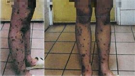 刺青婊子恐佈傷勢曝光　惡劣男是經紀霸總