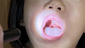 苗栗3歲童餐後喉嚨痛  就醫發現感染腸病毒苗栗縣一名3歲女童用餐後喉嚨痛，家長原以為吃魚遭魚刺刺傷，就醫檢查才發現是感染腸病毒A71型典型手足口症狀，女童經收治住院治療後，已獲得改善。（為恭紀念醫院提供）中央社記者管瑞平傳真  113年5月15日