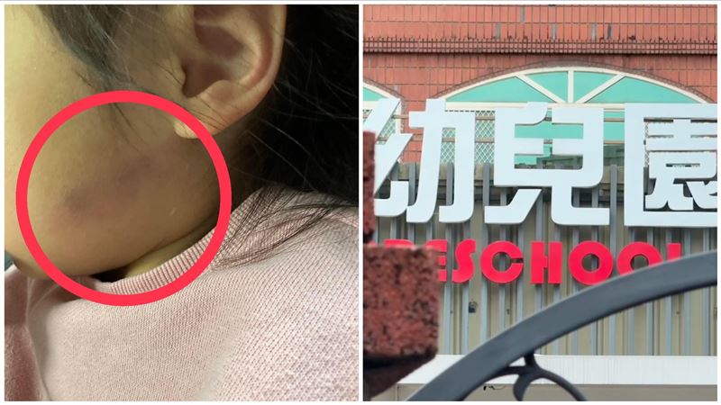 新竹3歲童雙耳被師捏瘀青　幼兒園說話了