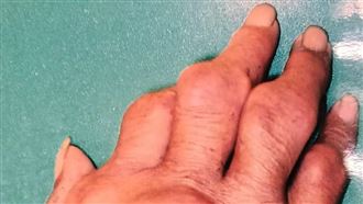 愛喝酒、飲料、狂吃海鮮　男痛風手腫變形