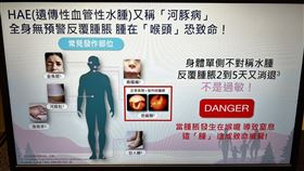 HAE患者若腫脹發作位置在喉頭，10幾分鐘就可能造成呼吸道堵塞奪命。（圖／記者簡浩正攝影）