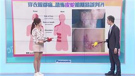 皮蛇,壓力,帶狀皰疹,免疫力,病毒,黃世聰