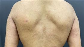 生物製劑治療前、後。（圖／安南醫院提供）