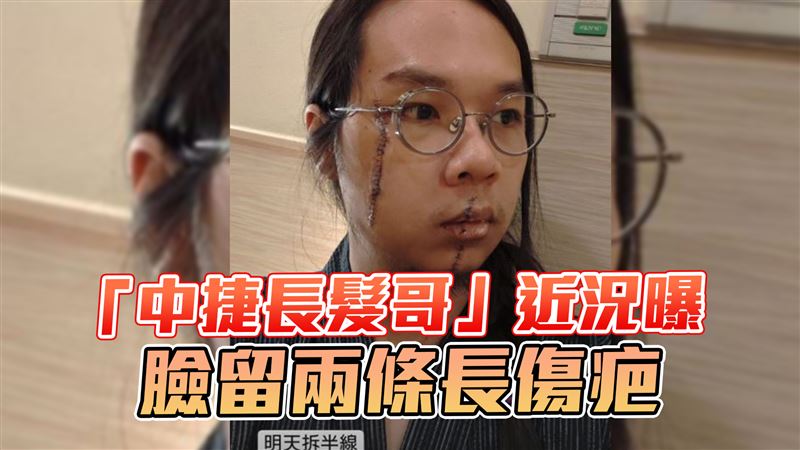 動員醫美團隊！他喊話：幫長髮哥免費除疤
