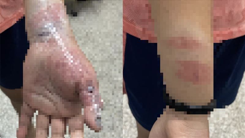 雲林狠師棍子狂抽女童！手心指甲瘀血發紫