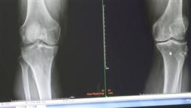 長期每天站12小時，激烈「16蹲」，小吃店老闆膝蓋操過度，嚴重磨損，置換人工關節(圖／大甲李綜合醫院提供)