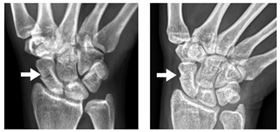李育成醫師說明，案例彭小姐在經由近兩個月治療後，可由X光看出骨頭有明顯的癒合。（圖／新竹臺大分院提供）