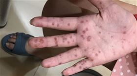 腸病毒個案。（圖／兒科醫師施勝桓提供）