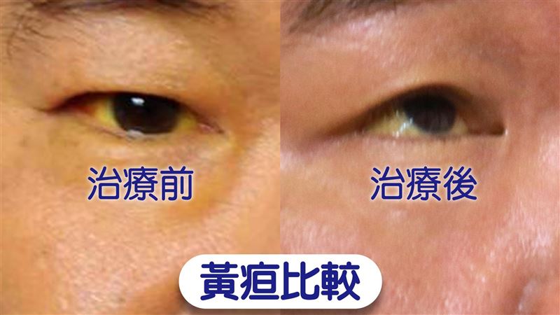 老闆每天準備飲料　40歲男喝到差點要換肝