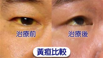 貼心老闆每天準備飲料！40歲男喝到「全身泛黃」　醫驚：差點要換肝