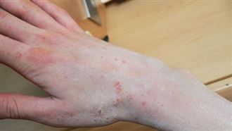 疥蟎「在你身上吸血產卵」！醫曝1行為恐遭百萬隻感染　3招消滅