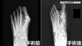 小模長期穿高跟鞋痛爆　脫鞋…2腳趾交疊（圖／亞大醫院）