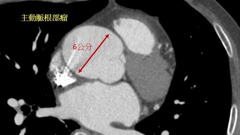 53歲老菸槍 健檢才知長5.3公分主動脈瘤