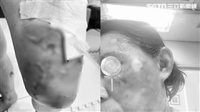 郭小姐嫂嫂2度燙傷相當嚴重，傷口遍佈臉部到腳步全身，皮膚都被燙破皺摺縮水，每天除了要清創換藥，後續還有很長的醫療要走
（圖／翻攝畫面）