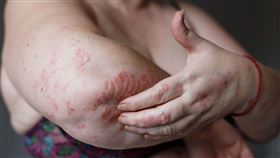 中醫,袁國山,皮膚癢,乾癬,跨年,皮膚科
圖／袁國山中醫師提供