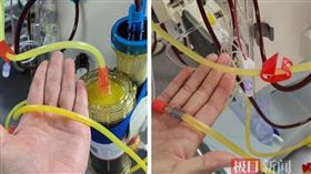 大陸58歲男血檢，抽出半管煉乳，高血脂，傻眼問：我才56公斤(圖／翻攝自極目新聞)