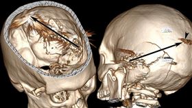 醫師在期刊上分享頭部中彈的病例（圖／翻攝自American Journal of Case Reports）