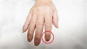 ▲甲床鱗狀細胞癌是指甲常見癌症。（圖／國泰醫院提供）