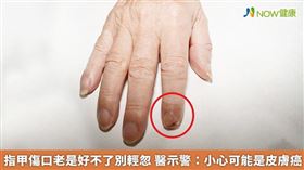名家專用／因此若是發現指甲異常或傷口久不癒合，一定要提高警覺，及早就醫。（勿用）
