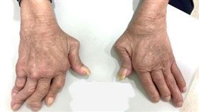 類風濕性關節炎示意圖。（圖／風濕病基金會台灣抗風濕病聯盟提供）