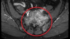 核磁共振影像-癌細胞轉移脊椎（圖／亞大醫院提供）