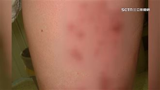 當心帶狀疱疹！　50歲+免疫低下者勿輕忽