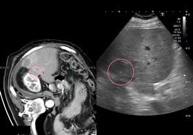 年輕應酬拚酒老年罹肝癌　醫祭六招對付(圖/翻攝畫面)