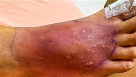 姜冠宇醫師提醒，天熱劇烈起來，你也會有危險，圖為其中一位蜂窩組織炎到冒泡的案例。（圖／姜冠宇醫師授權使用）

