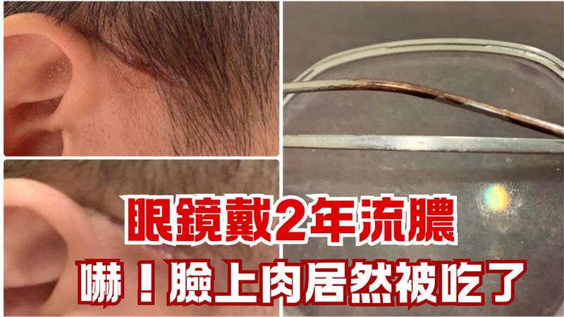 戴眼鏡2年「皮膚發紅流膿」！醫：腐蝕了