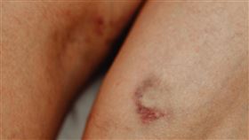 紅疹 瘀青 受傷 示意圖/pexels