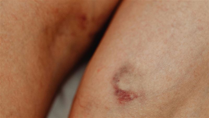 他突冒大片瘀青 一驗血癌！「2部位」最慘