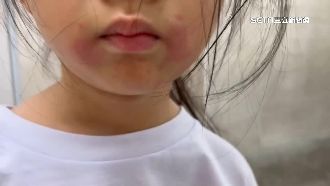 獨／女童游泳完爆蕁麻疹　桃運動中心回應