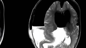 大陸一名1歲女嬰因為動作發展遲緩被送往醫院檢查。 經檢查後發現，女嬰腦中有一個胎兒形狀的屍體，疑似是女嬰的雙胞胎。 （圖／翻攝自X）