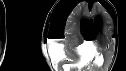 女嬰行動遲緩！檢查見「大腦寄生胎中胎」