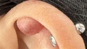 ▲林小姐在耳廓穿耳洞後出現2公分大肉球。（圖／書田診所提供）