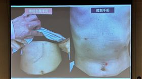 醫師說明肝癌手術個案。（圖／記者簡浩正攝影）