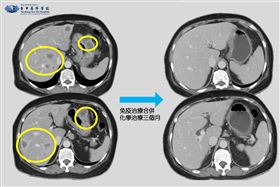 免疫治療合併化學治療三個月前後比對。（圖／台中慈濟醫院提供）