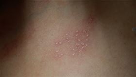 忽略這事…爸染皮蛇害不到1歲女兒長水痘　妻後來也中鏢！（圖／台中慈院提供）