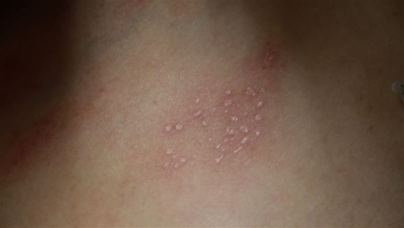 全家得水痘爸爸住院一週 醫:非常危險