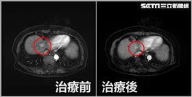 8旬嬤治癒C肝又續發肝癌　1招殺光癌細胞(圖/翻攝畫面)