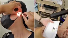 耳朵飄濃烈臭味！25歲男「聽不到女友碎唸」　醫挖超大塊屎
(組合圖／翻攝自陳亮宇醫師 / 陳亮宇耳鼻喉科診所 臉書)
