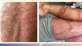 陳小姐分享病情發作時全身上下甚至會陰部，都長滿整片膿疱，真的很可怕。（圖／陳小姐提供）
