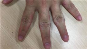 治療前余同學的中指及無名指關節莫名腫大(左)；治療四個月腫脹已有明顯減少，目前仍在治療中(右)（圖／台北慈濟醫院提供）