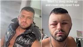 英國,染頭髮,染髮劑,過敏,氣球,腫脹（圖／翻攝New York Post）