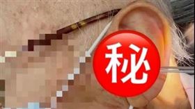 2年多未清理耳朵，老翁急就醫挖出「超大耳垢」。（圖／張益豪醫師提供）