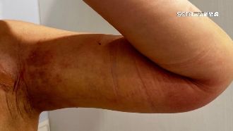 獨／術前不讓問　女控醫美診所掉包抽脂機