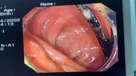 電腦斷層顯示，男子的腸壁遭穿孔。（圖／翻攝自廣州日報）