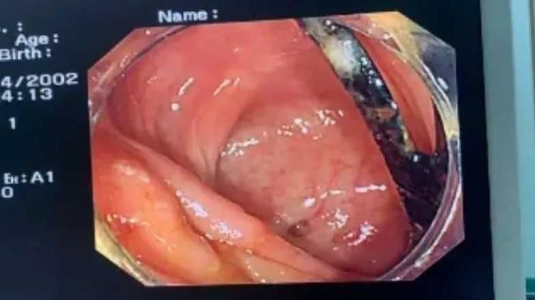 中年男腹痛3個月！醫驚見「叉子」刺腸壁
