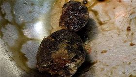 以腹腔鏡手術取出兩顆分別為2.5公分及1.5公分的膽結石。（圖／大千綜合醫院提供）